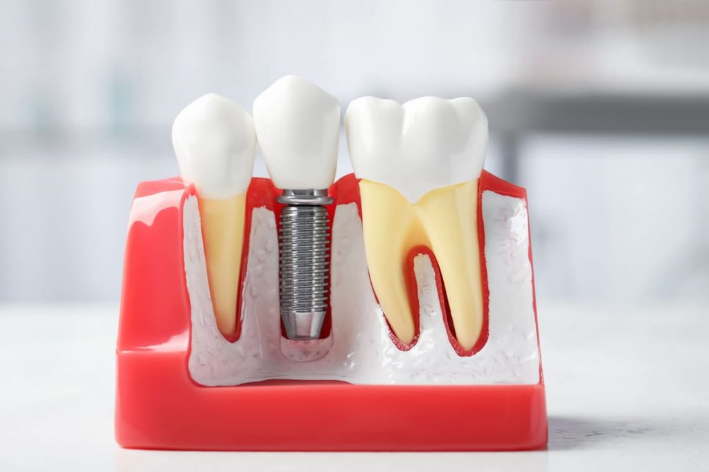 implantes en el dentista sin dolor